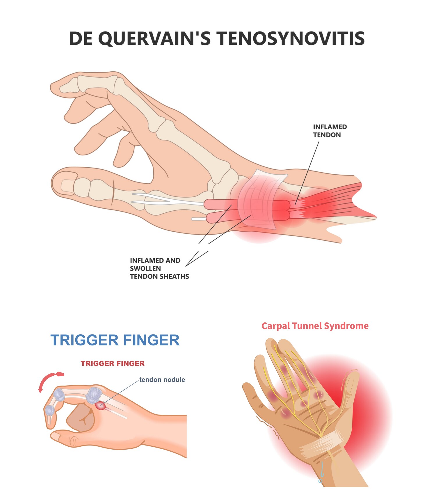 Wrist & Hand Pain / Trigger Finger anatomy diagram